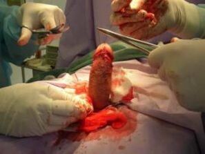 penis büyütme ameliyatı